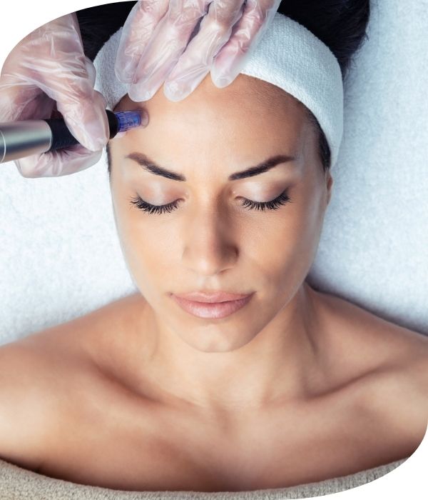 microneedling microneedling