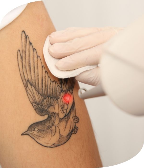 eliminacion de tatuajes con laser eliminacion de tatuajes con laser